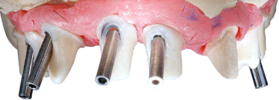 Axis direction front tooth