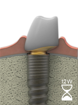 LTS-Hybrid-Abutment eingeheilt