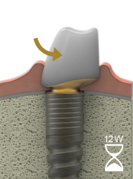 LTS-Hybrid-Abutments eingeheilt