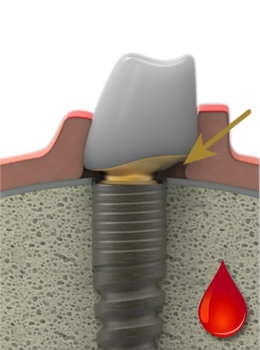 LTS-Hybrid-Abutment zum Zeitpunkt der Implantation