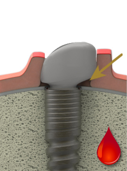 LTS-healingcap at the time of implantation