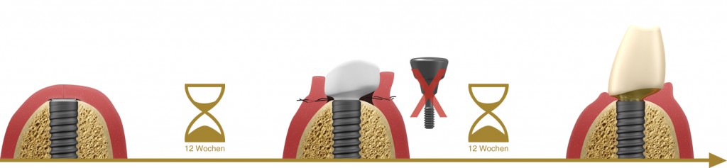 a4l-lts-base-umstellungsschritt1