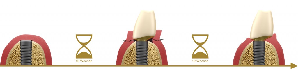 a4l-lts-base-umstellungsschritt2