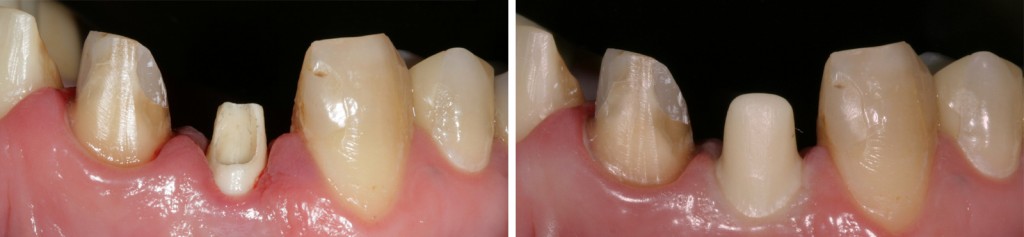 gerade-vs-abgewinkelt2