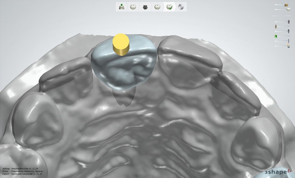 lts-Base-Frontzahn--gerader-Schraubenkanal-okklusal