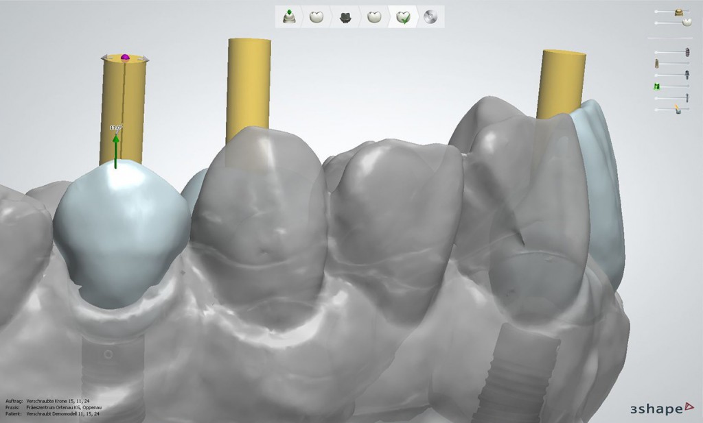 lts-base-3shape-abgewinkelter-Schraubenkanal-lateral