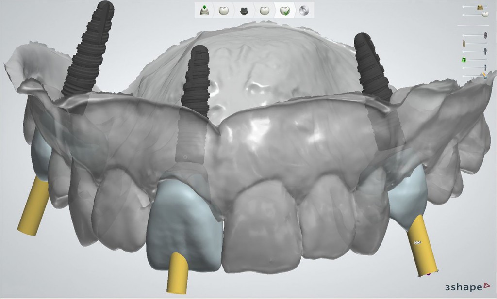 lts-base-gerader-schraubenkanal-front