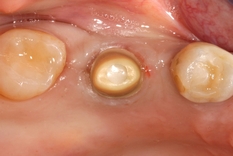 Molar - upper jaw